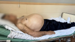 Донские хирурги удалили злокачественную опухоль весом 15 кг пенсионеру из Ростовской области